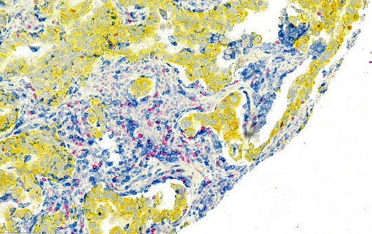 Lung Adenocarcinoma: CD4, CD8, PanCK 15x. Biomax TMA.